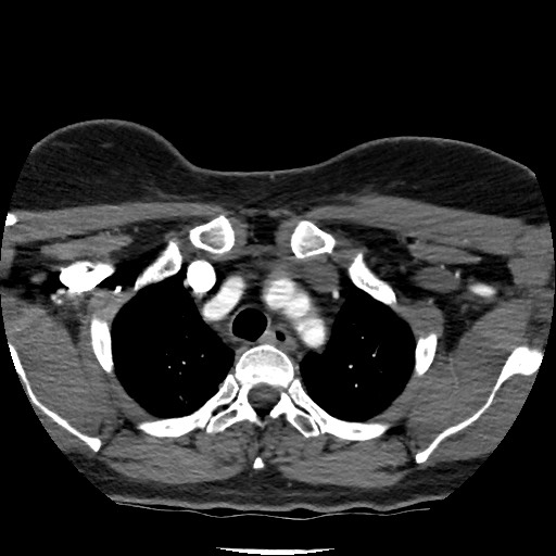 Acute subarachnoid hemorrhage and accessory anterior cerebral artery (Radiopaedia 69231-79009 Axial C+ arterial phase 19).jpg