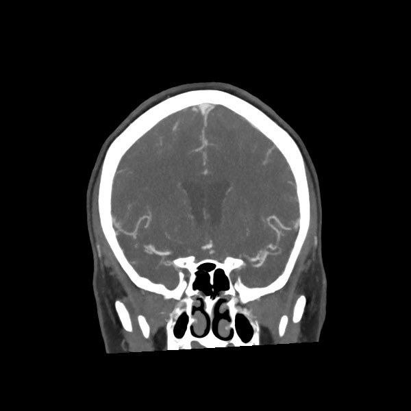 Acute subarachnoid hemorrhage and accessory anterior cerebral artery (Radiopaedia 69231-79009 Coronal C+ arterial phase 33).jpg