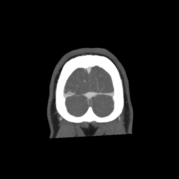 Acute subarachnoid hemorrhage and accessory anterior cerebral artery (Radiopaedia 69231-79009 Coronal C+ arterial phase 76).jpg