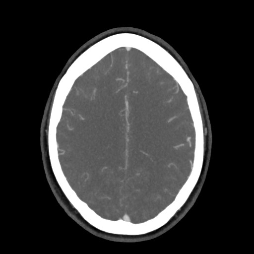 Acute subarachnoid hemorrhage and accessory anterior cerebral artery (Radiopaedia 69231-79009 D 48).jpg