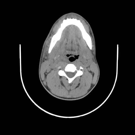 File:Acute submandibular sialadenitis secondary to ductal stone (Radiopaedia 27999-28267 Axial non-contrast 12).jpg
