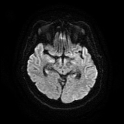 Acute superior cerebellar artery territory infarct (Radiopaedia 84104-99358 Axial DWI 52).jpg