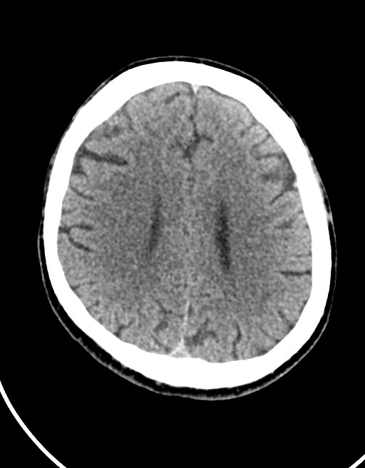 Acute superior cerebellar artery territory infarct (Radiopaedia 84104-99359 Axial non-contrast 26).jpg