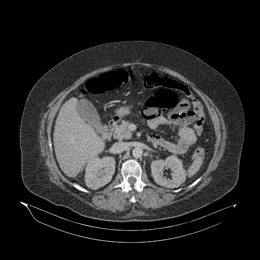 File:Acute superior mesenteric artery occlusion (Radiopaedia 51288-56960 Axial C+ portal venous phase 37).jpg