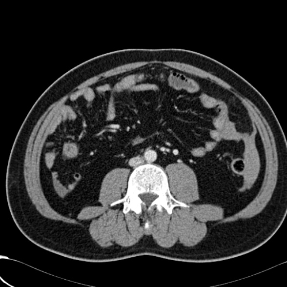 File:Acute traumatic mesenteric bleed (Radiopaedia 37561-39428 Axial C+ portal venous phase 96).jpg