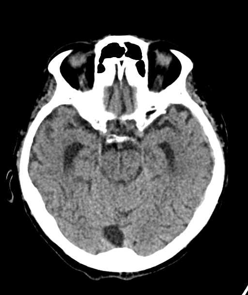 Acute traumatic subdural hematoma (Radiopaedia 82921-97257 Axial non-contrast 42).jpg