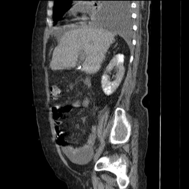 Acute tubular necrosis (Radiopaedia 28077-28334 H 33).jpg