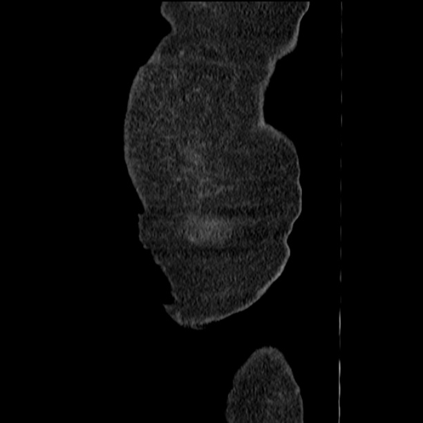 Acute tubular necrosis (Radiopaedia 28077-28334 Sagittal non-contrast 2).jpg