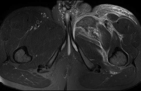 File:Adductor longus tear with retraction (Radiopaedia 56424-63103 Axial T2 fat sat 27).jpg