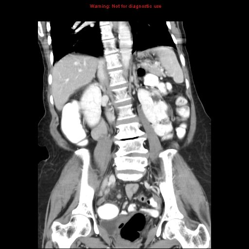 File:Adenocarcinoma of the colon (Radiopaedia 8191-9039 Coronal liver window 28).jpg