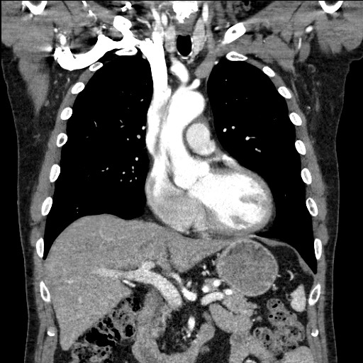 Adenocarcinoma of the lung (Radiopaedia 59871-67325 Coronal C+ arterial phase 27).jpg