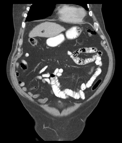 Adenocarcioma of rectum- T1 lesion (Radiopaedia 36921-38547 Coronal C+ portal venous phase 18).png