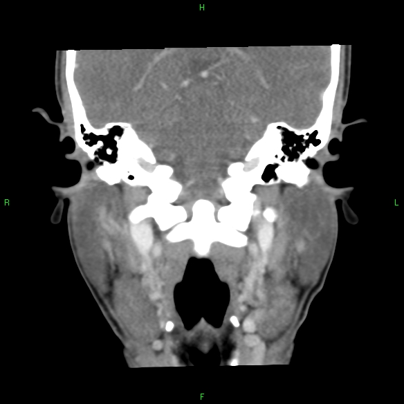 File:Adenoid cystic carcinoma of hard palate (Radiopaedia 26137-26273 Coronal liver window 25).jpg