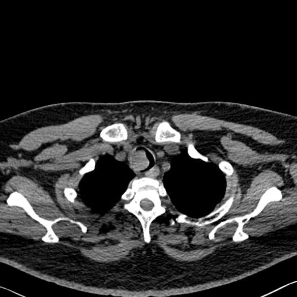 Adenoid cystic carcinoma of the trachea (Radiopaedia 49042-54137 Axial non-contrast 40).jpg