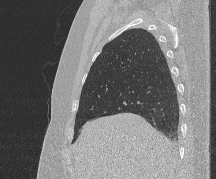 Adenoid cystic carcinoma of the trachea (Radiopaedia 49042-54137 Sagittal lung window 101).jpg