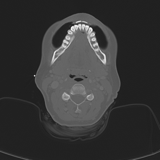 Adenoid cystic tumor of palate (Radiopaedia 46980-51518 Axial bone window 39).png