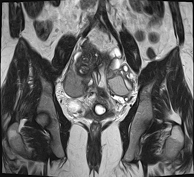 File:Adenomyosis - ovarian endometriomas (Radiopaedia 67031-76350 Coronal T2 17).jpg