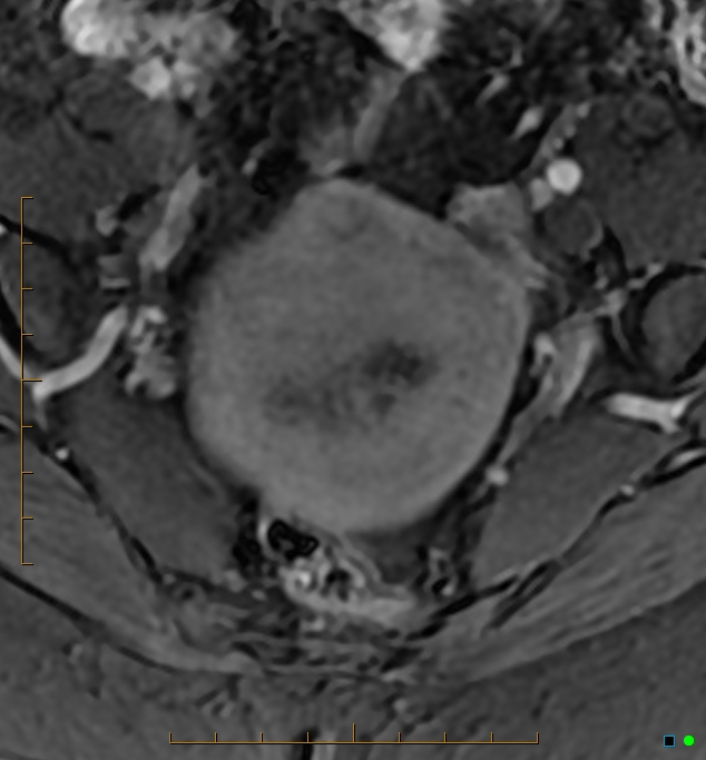 Adenomyosis uterus with hematometra (Radiopaedia 45779-50011 Axial T1 C+ fat sat 12).jpg