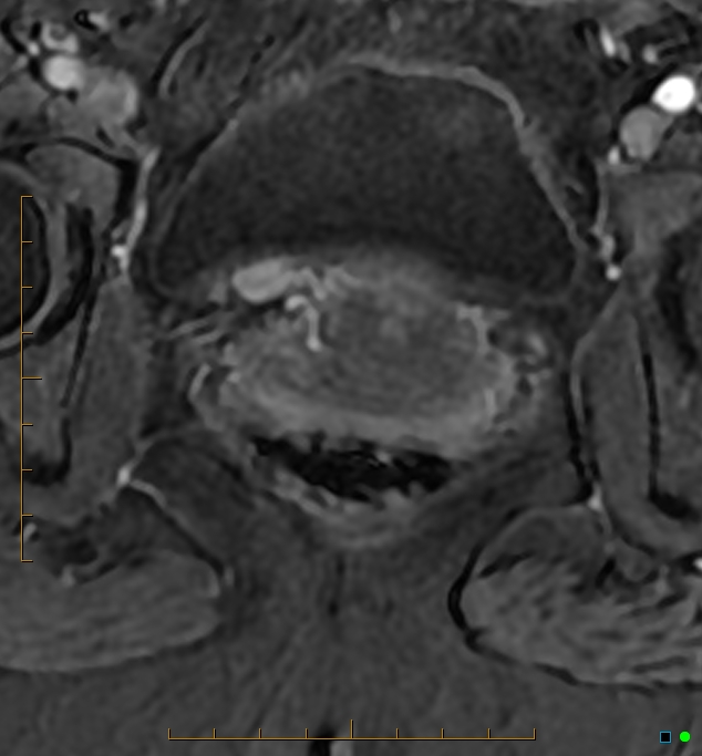 Adenomyosis uterus with hematometra (Radiopaedia 45779-50011 Axial T1 C+ fat sat 54).jpg