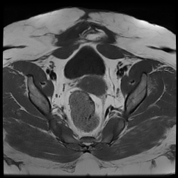 File:Adenomyosis within a didelphys uterus (Radiopaedia 70175-80215 Axial T1 26).jpg