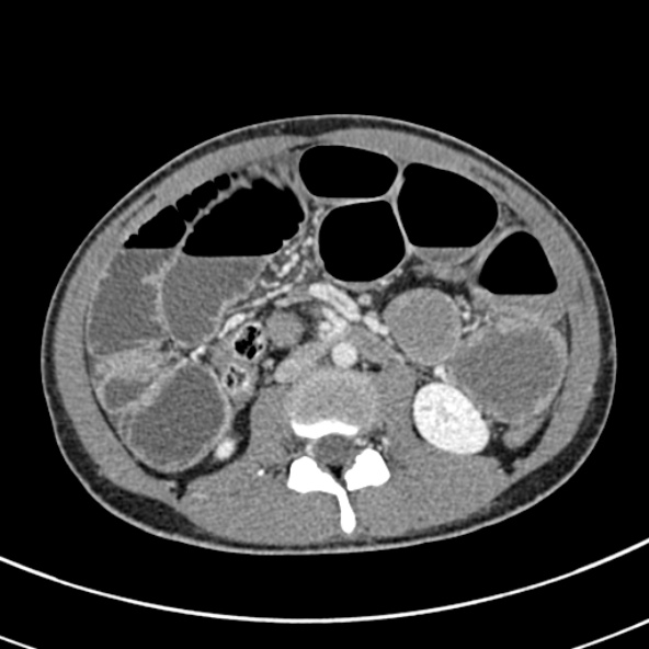 File:Adhesional small bowel obstruction (Radiopaedia 52107-57980 Axial C+ portal venous phase 57).jpg