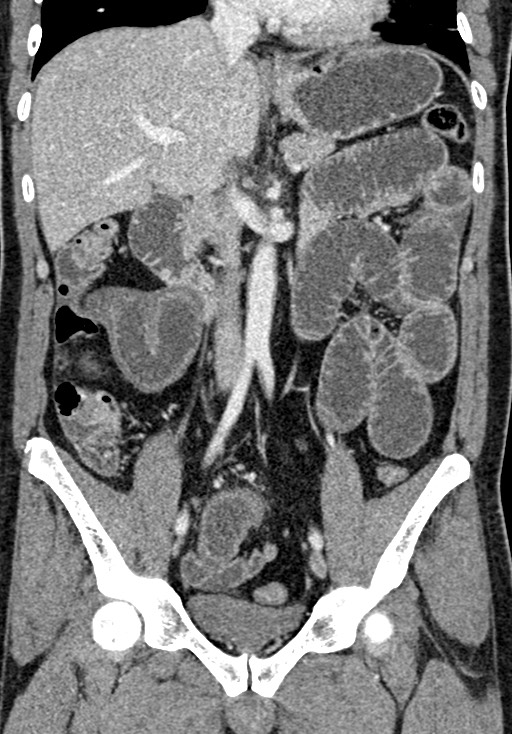 Adhesional small bowel obstruction (Radiopaedia 58900-66131 Coronal C+ portal venous phase 138).jpg