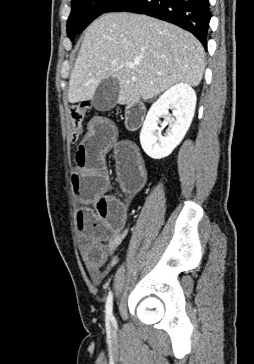 Adhesional small bowel obstruction (Radiopaedia 58900-66131 Sagittal C+ portal venous phase 72).jpg