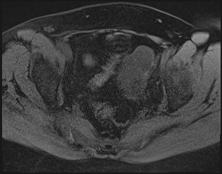 File:Adnexal multilocular cyst (O-RADS US 3. O-RADS MRI 3) (Radiopaedia 87426-103754 Axial 181).jpeg