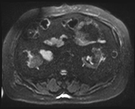 Adrenal cortical carcinoma (Radiopaedia 64017-72770 Axial DWI 65).jpg