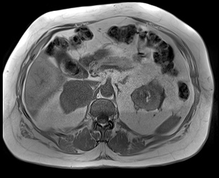 File:Adrenal cortical carcinoma (Radiopaedia 64017-72770 Axial T1 in-phase 31).jpg