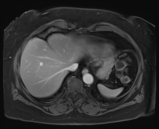 Adrenal cortical carcinoma (Radiopaedia 64017-72770 J 7).jpg