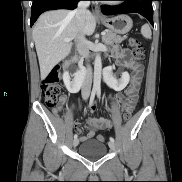 Adrenal cystic lymphangioma (Radiopaedia 83161-97534 Coronal C+ portal venous phase 34).jpg