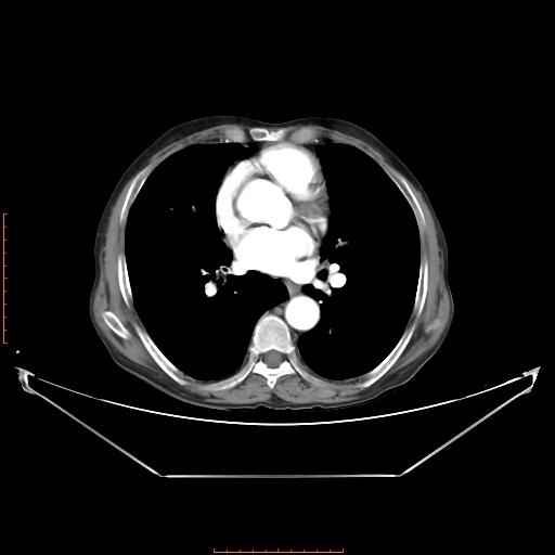 Adrenal hemangioma (Radiopaedia 68923-78668 Axial C+ arterial phase 2).jpg