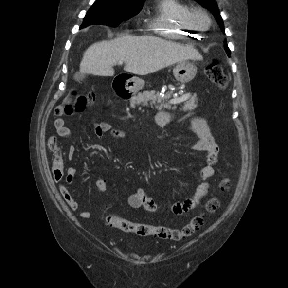 Adrenal lymphoma (Radiopaedia 84145-99415 Coronal C+ portal venous phase 24).jpg