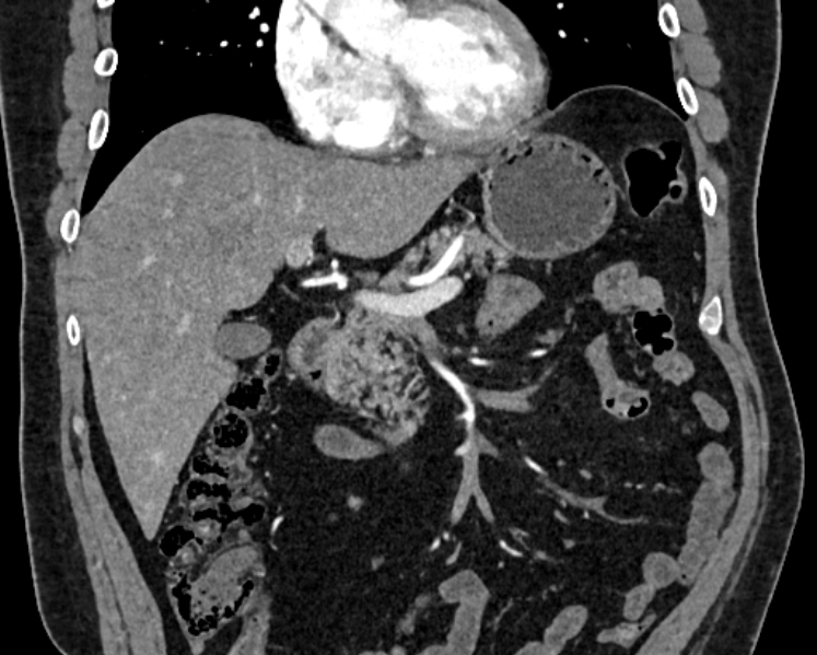 File:Adrenal metastases (Radiopaedia 73082-83791 Coronal C+ arterial phase 1).jpg