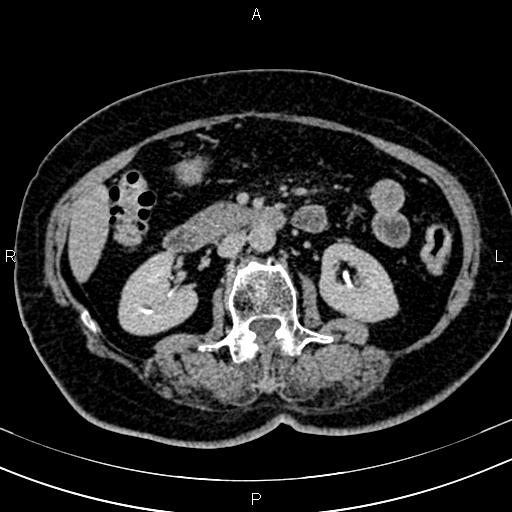 Adrenal myelolipoma (Radiopaedia 82742-96986 Axial renal excretory phase 67).jpg