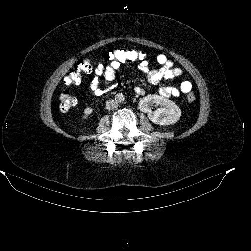 Adrenal myelolipoma (Radiopaedia 84319-99617 Axial renal cortical phase 62).jpg