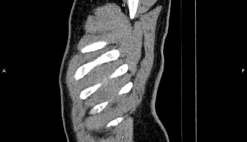 Adrenal myelolipoma (Radiopaedia 84321-99619 Sagittal non-contrast 106).jpg