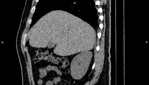 Adrenal myelolipoma (Radiopaedia 84321-99619 Sagittal non-contrast 26).jpg