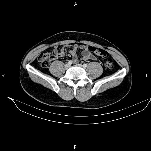 Adrenal myelolipoma (Radiopaedia 87794-104246 Axial renal cortical phase 73).jpg