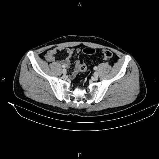Adrenal myelolipoma (Radiopaedia 87794-104246 Axial renal cortical phase 85).jpg