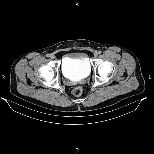 Adrenal myelolipoma (Radiopaedia 87794-104246 Axial renal excretory phase 99).jpg
