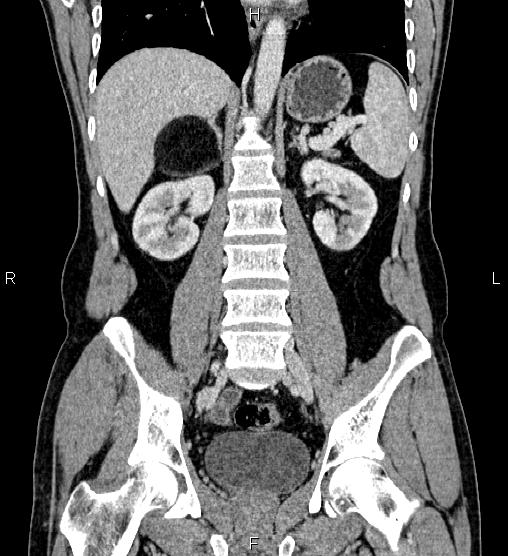 Adrenal myelolipoma (Radiopaedia 87794-104246 Coronal renal cortical phase 39).jpg