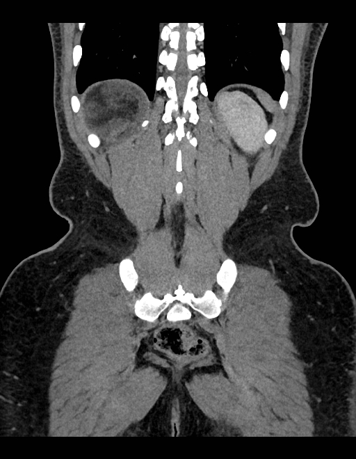 Adrenal myelolipoma - bilateral (Radiopaedia 74805-85810 Coronal C+ portal venous phase 74).jpg