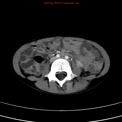 File:Adrenocortical carcinoma (Radiopaedia 9449-10131 Axial C+ portal venous phase 35).jpg