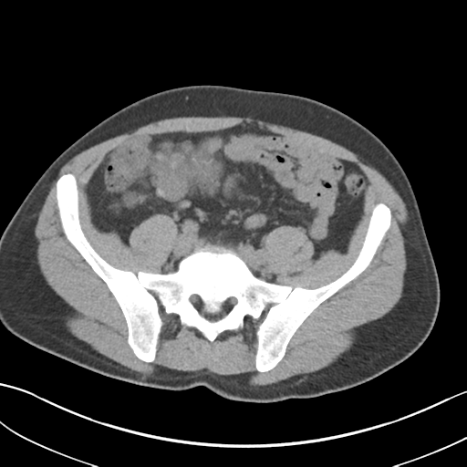 File:Adult polycystic kidney disease (Radiopaedia 47866-52626 Axial non-contrast 59).png