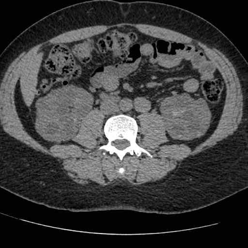Adult polycystic kidney disease (Radiopaedia 59075-66368 Axial non-contrast 47).jpg