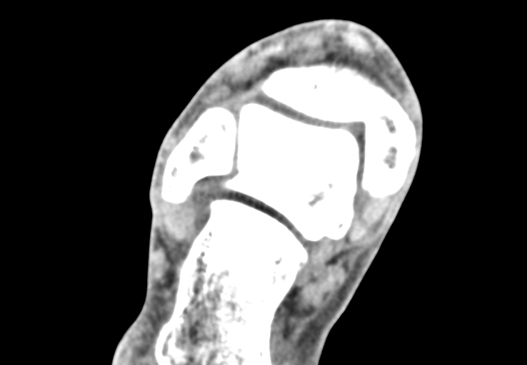 Advanced osteomyelitis due to open metatarsal fracture (Radiopaedia 83891-99095 Axial non-contrast 5).jpg