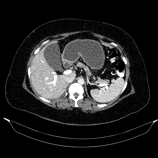 File:Afferent loop syndrome - secondary to incarcerated trocar site hernia (Radiopaedia 82959-97305 Axial C+ portal venous phase 65).jpg