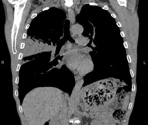 Air bronchogram in pneumonia (Radiopaedia 85719-101512 Coronal non-contrast 31).jpg